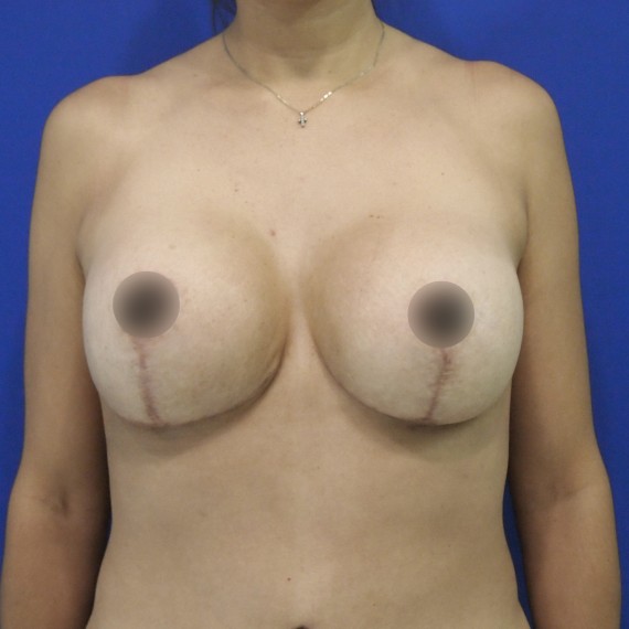 imagen despues Mamopexia con implante